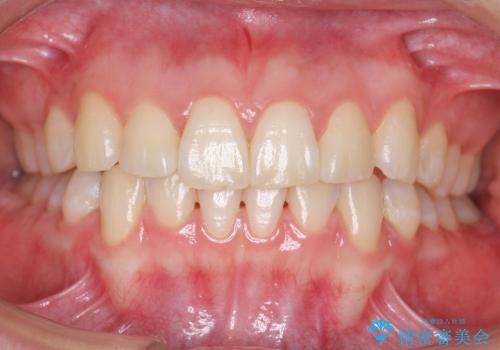 [20代女性]　前歯のねじれ　抜かない、見えない矯正の治療後