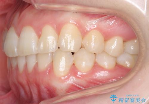 [20代女性]　前歯のねじれ　抜かない、見えない矯正の治療後