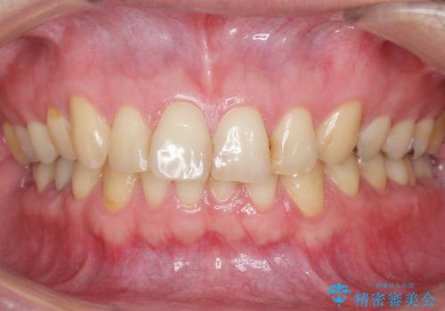 奥歯の違和感　神経がない歯のう蝕　30代男性の治療後