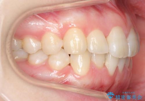 [20代女性]　前歯のねじれ　抜かない、見えない矯正の治療中