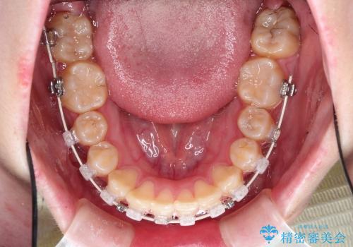 20代女性　八重歯の抜歯矯正の治療中