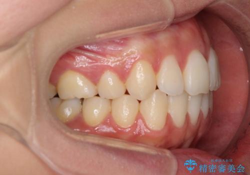 出っ歯　上顎前突の抜歯矯正の治療後