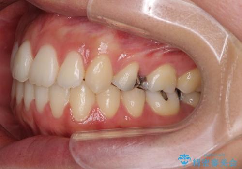 出っ歯　上顎前突の抜歯矯正の治療後