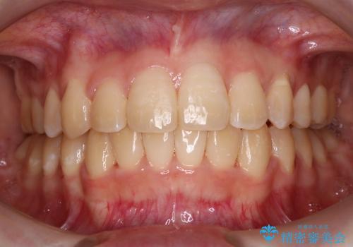 20代女性　八重歯の抜歯矯正の治療後