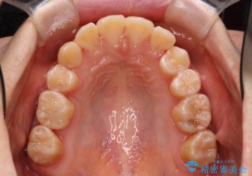 20代女性　八重歯の抜歯矯正の治療後