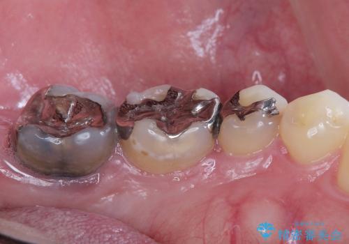 奥歯の違和感　神経がない歯のう蝕　30代男性の治療前