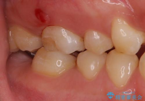 上顎大臼歯にはゴールドクラウンがおすすめの治療前