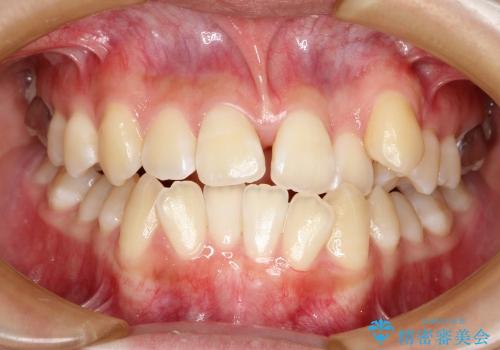 上顎の骨を拡大　非抜歯による八重歯の矯正治療の治療中