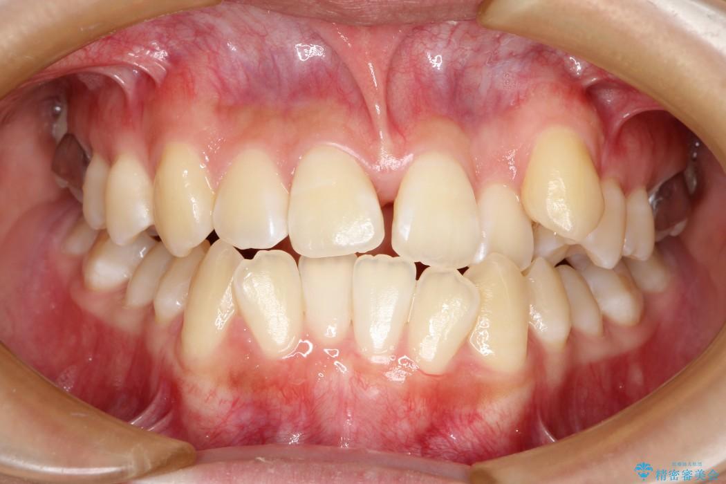 上顎の骨を拡大 非抜歯による八重歯の矯正治療｜（医）精密審美会