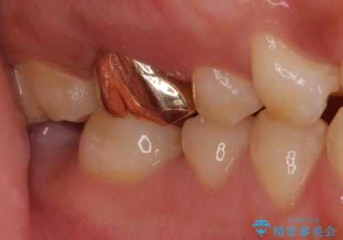 上顎大臼歯にはゴールドクラウンがおすすめの治療後