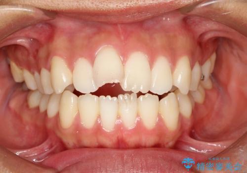 出っ歯　上顎前突の抜歯矯正の治療前