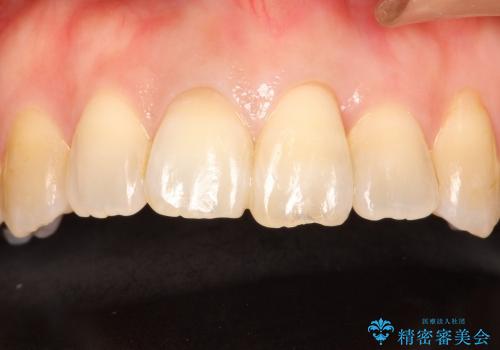 状況によっては　歯の変色もホワイトニングで白くできるの治療後