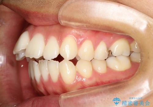 出っ歯　上顎前突の抜歯矯正の治療前