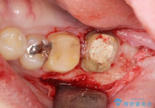 奥歯の違和感　神経がない歯のう蝕　30代男性の治療中
