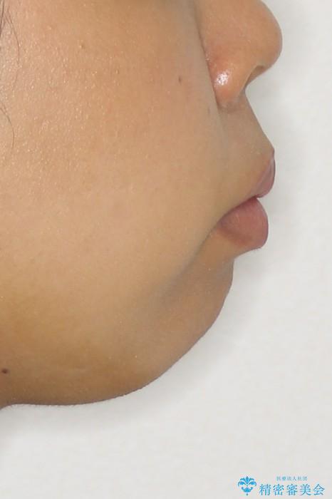 出っ歯　上顎前突の抜歯矯正の治療前（顔貌）