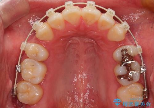 出っ歯　上顎前突の抜歯矯正の治療中
