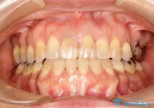状況によっては　歯の変色もホワイトニングで白くできるの治療中