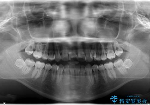 上顎の骨を拡大　非抜歯による八重歯の矯正治療の治療前