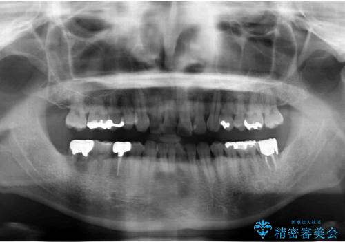 奥歯の違和感　神経がない歯のう蝕　30代男性の治療前