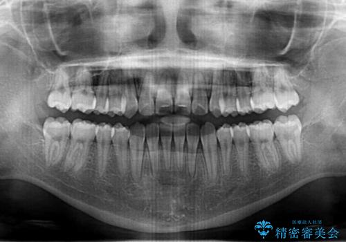 上顎の骨を拡大　非抜歯による八重歯の矯正治療の治療後