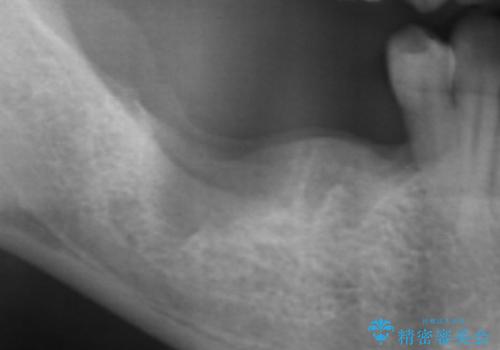 [重度歯周病] 骨造成を伴うインプラント咬合機能回復治療の治療前
