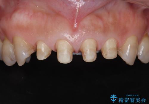 [前歯の審美治療] 変色した前歯をセラミック治療の治療中