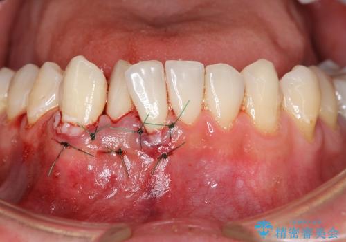 [歯ぐきの再生治療] 矯正治療前の歯ぐき移植の治療中