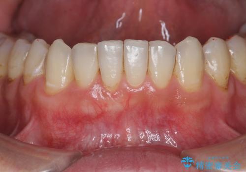 [歯ぐきの再生治療] 矯正治療前の歯ぐき移植の治療後