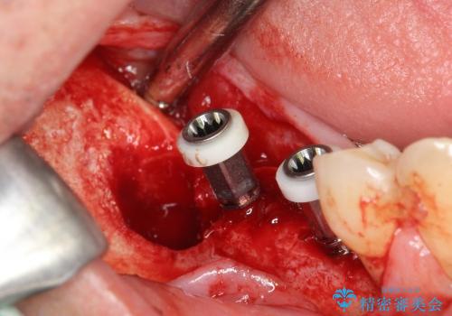 [重度歯周病] 骨造成を伴うインプラント咬合機能回復治療の治療中