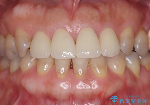 [前歯の審美治療] 変色した前歯をセラミック治療の治療後