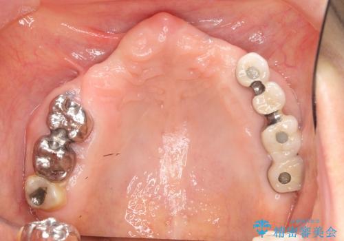 [前歯の審美・機能回復] 前歯を複数本失った場合 3つの治療方法の治療前