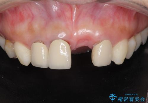 [前歯の審美・機能回復]  前歯を1本失った場合 3つの治療方法