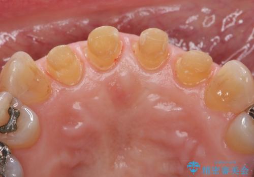 [前歯の審美治療] 変色した前歯をセラミック治療の治療中
