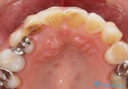 [前歯部ブリッジ治療①]  埋伏歯の抜歯ー歯ぐきの移植による顎堤増大の治療前