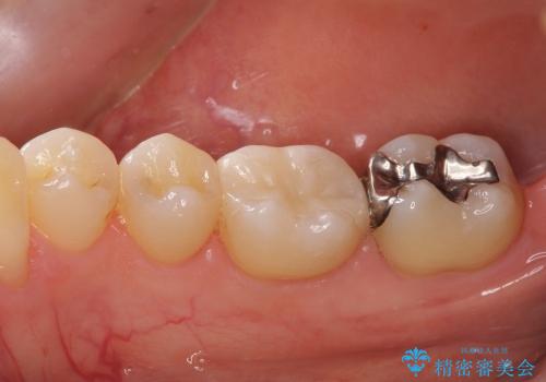 30代女性　歯と歯の間の虫歯に関する一例の治療後