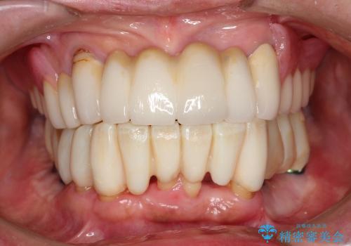 [インプラント支台義歯] マグネットアタッチメントを用いた噛める入れ歯の治療中