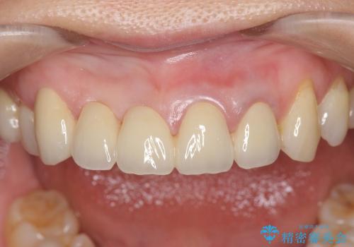 [ジルコニアブリッジ] 前歯部　審美ブリッジ補綴の治療後