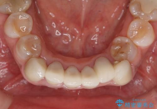 [テトラサイクリン歯]  前歯ラミネートからクラウンへのやりかえの治療後