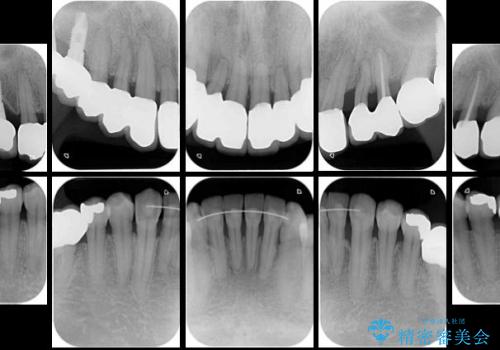 矯正治療を併用した全顎歯周病治療の治療後