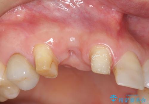 [前歯部ブリッジ治療①]  埋伏歯の抜歯ー歯ぐきの移植による顎堤増大の治療後