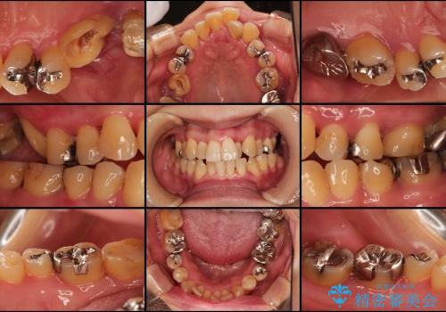矯正治療を併用した全顎歯周病治療の治療前