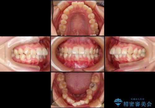 出っ歯を治したい　メタル装置による抜歯矯正の治療前