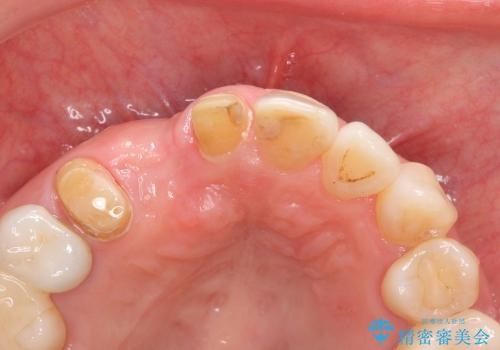 [前歯部ブリッジ治療①]  埋伏歯の抜歯ー歯ぐきの移植による顎堤増大の治療中