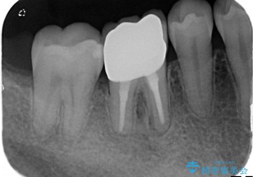 深いむし歯で型取りが困難な歯に適合のいい被せ物をの治療後