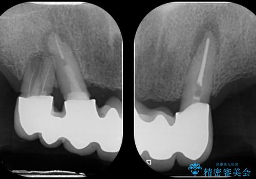 [インプラント支台義歯] マグネットアタッチメントを用いた噛める入れ歯の治療前
