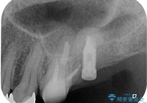根管治療とインプラント治療により奥歯をしっかりとしたかみ合わせへの治療中