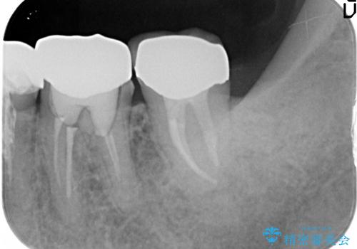 根管治療とインプラント治療により奥歯をしっかりとしたかみ合わせへの治療後