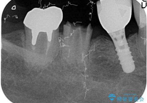 50代女性　奥歯が折れた→歯周外科・根管治療で再生の治療前