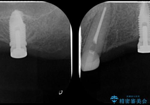 [インプラント支台義歯] マグネットアタッチメントを用いた噛める入れ歯の治療後