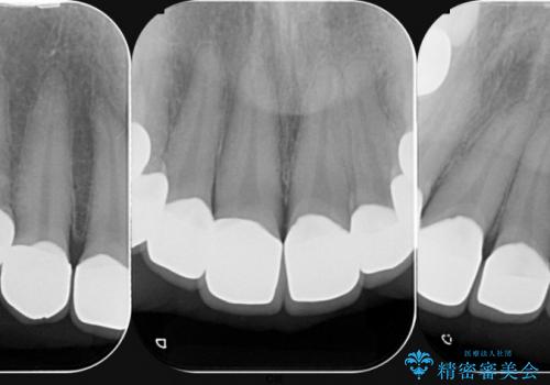 [テトラサイクリン歯]  前歯ラミネートからクラウンへのやりかえの治療後